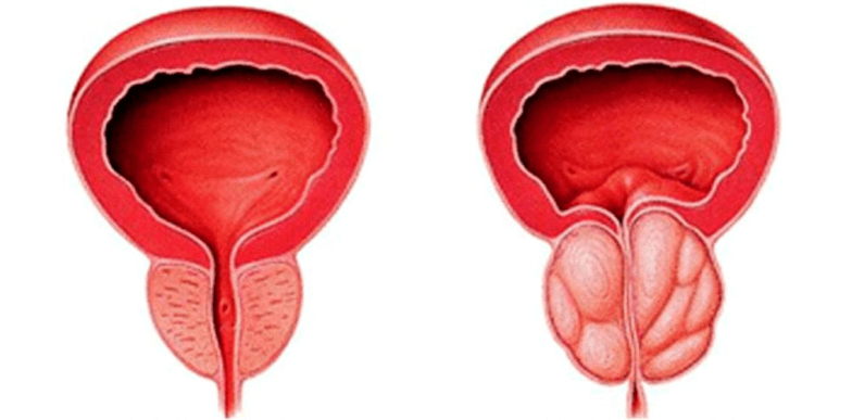 Normal and inflamed prostate gland